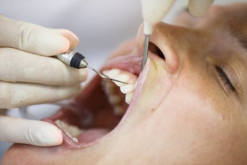 Parodontologie - Soins dentaires - Cliniques dentaires Bailli et Verbist à Bruxelles
