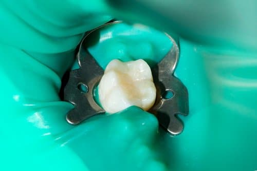 Endodontie - Soins dentaires - Cliniques dentaires Bailli et Verbist à Bruxelles