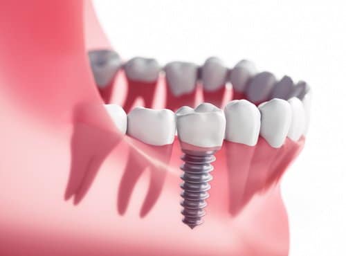 Implantologie - Soins dentaires - Cliniques dentaires Bailli et Verbist à Bruxelles