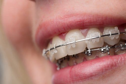 Orthodontie - Soins dentaires - Cliniques dentaires Bailli et Verbist à Bruxelles